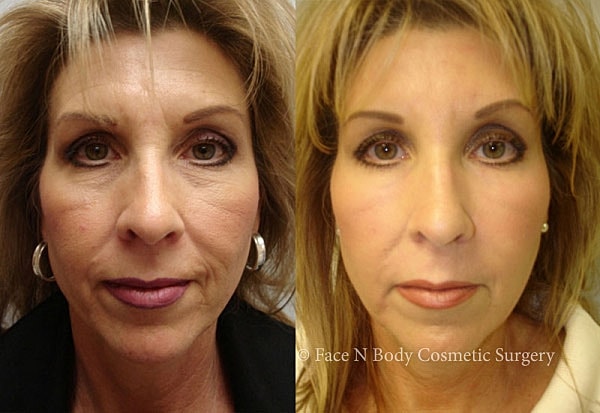 Laser Skin Resurfacing Before & After