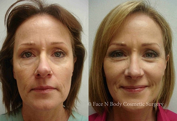 Laser Skin Resurfacing Before & After