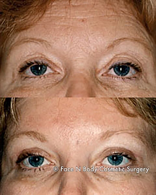 Brow Lift Before & After