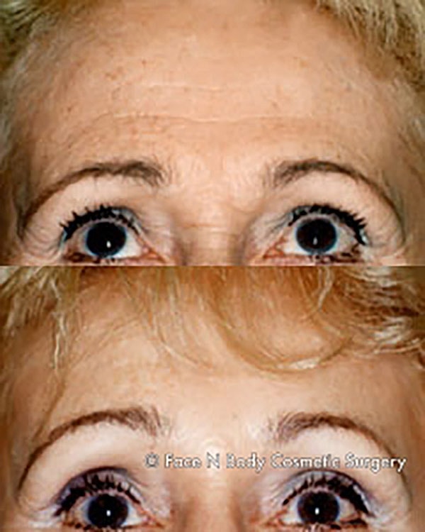 Brow Lift Before & After