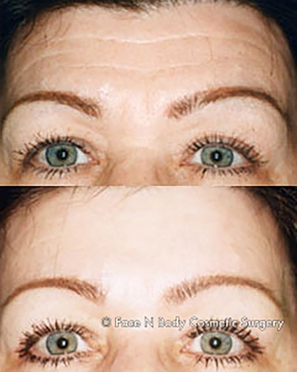 Brow Lift Before & After