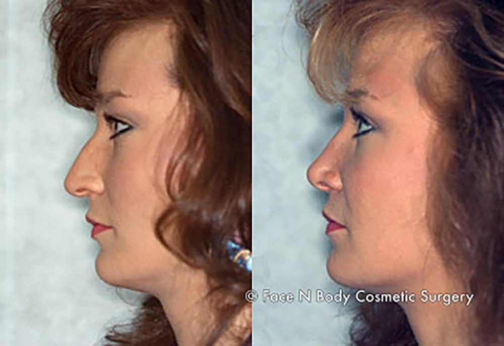 Rhinoplasty Before & After