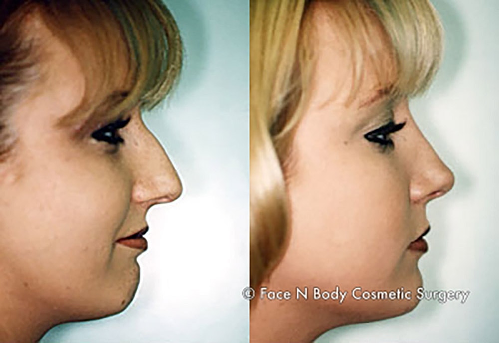 Rhinoplasty Before & After
