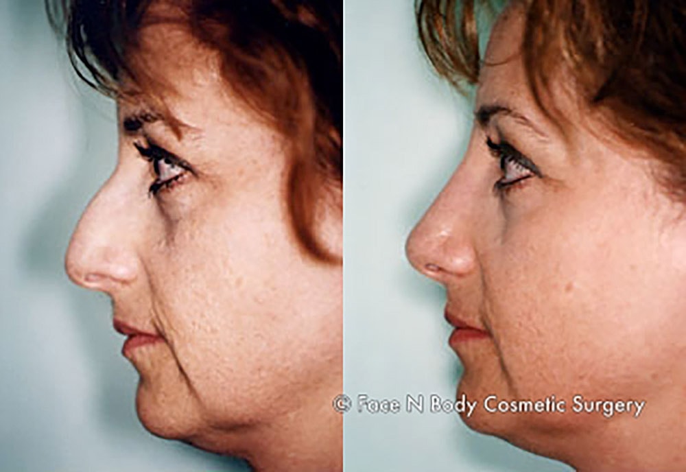 Rhinoplasty Before & After