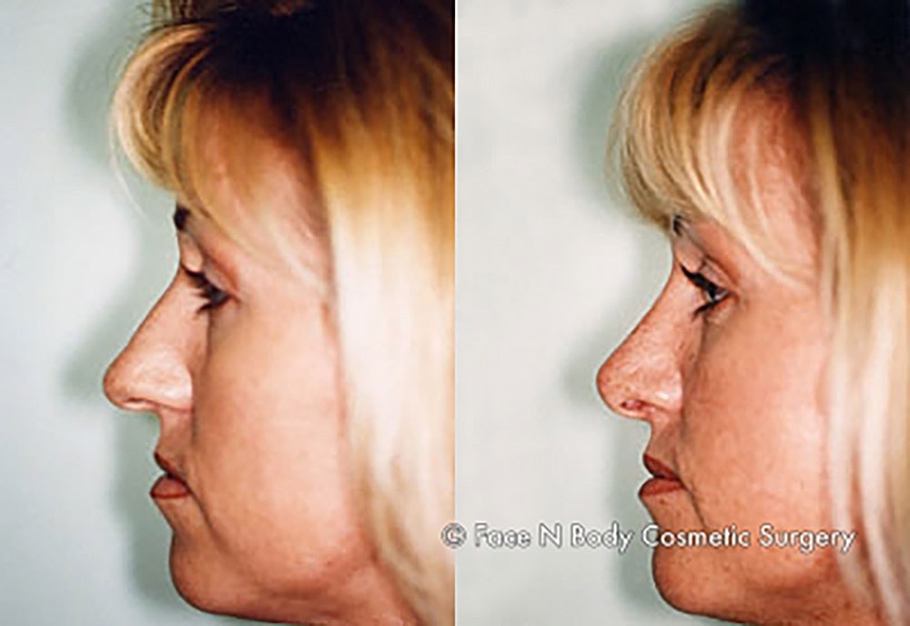 Rhinoplasty Before & After