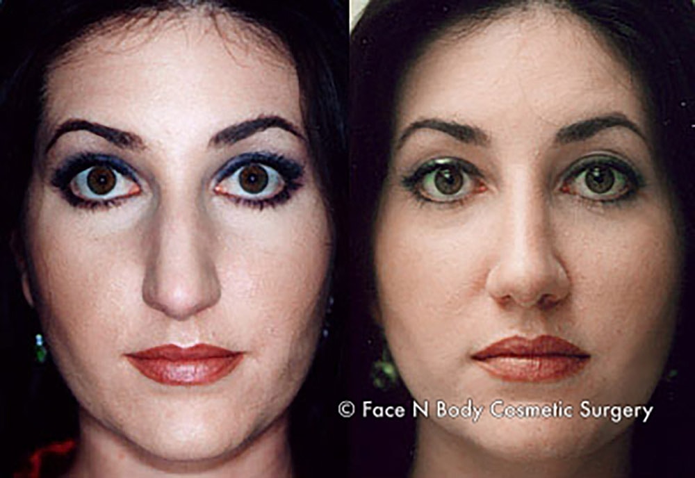 Rhinoplasty Before & After