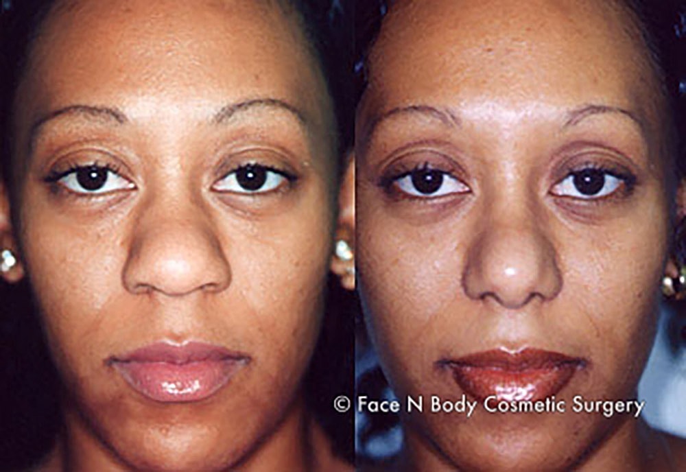 Rhinoplasty Before & After