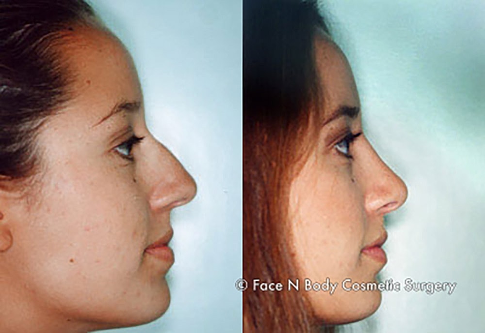 Rhinoplasty Before & After