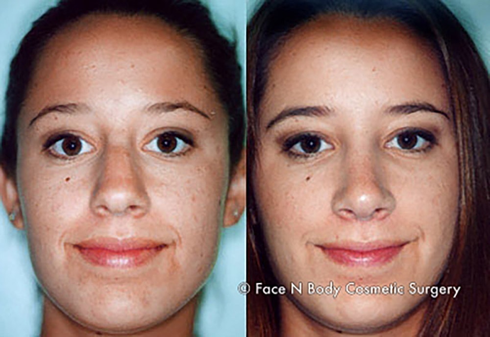 Rhinoplasty Before & After