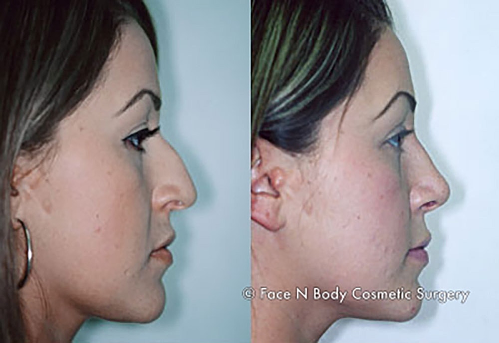 Rhinoplasty Before & After