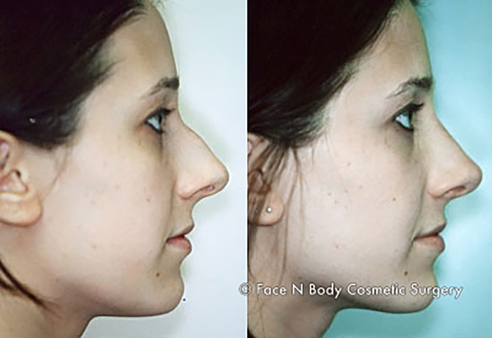 Rhinoplasty Before & After