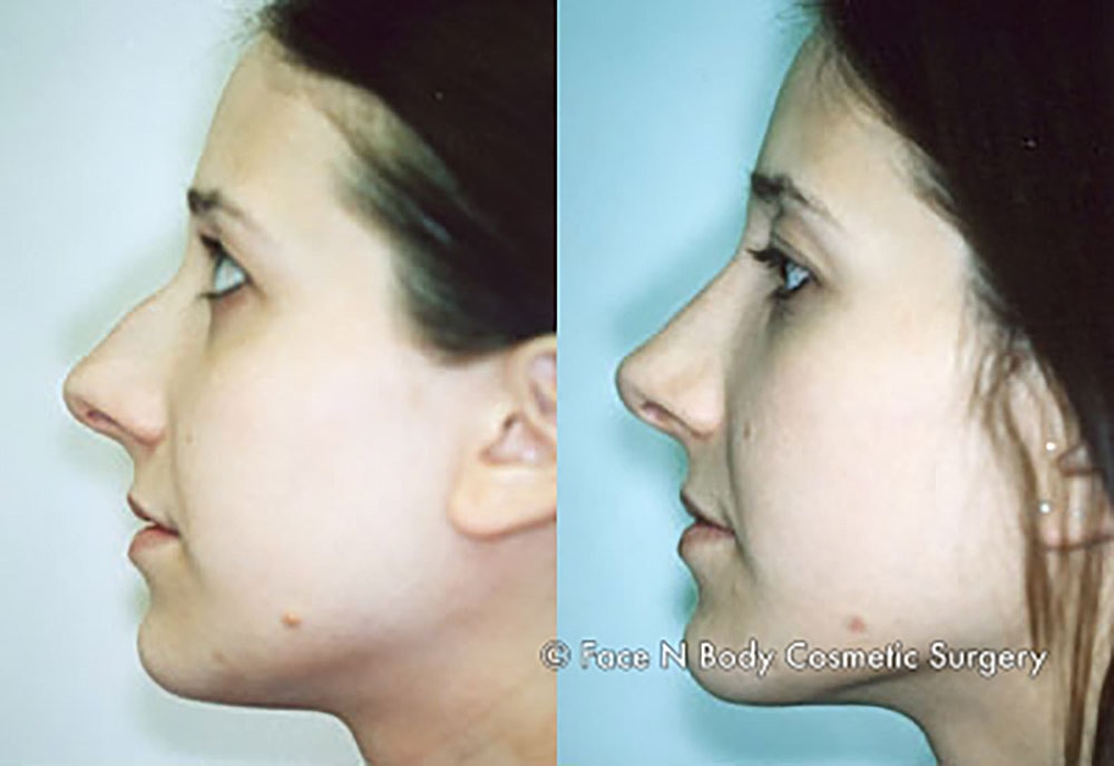 Rhinoplasty Before & After