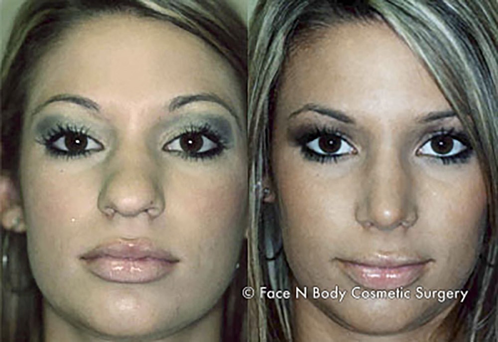 Rhinoplasty Before & After