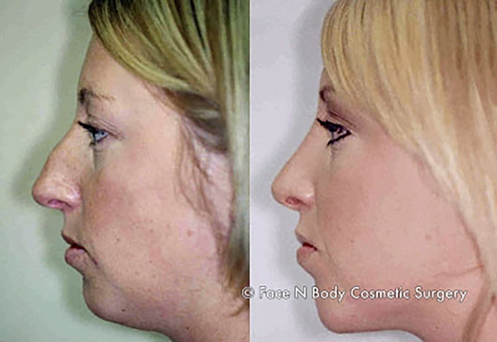 Rhinoplasty Before & After