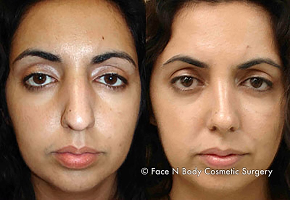 Rhinoplasty Before & After