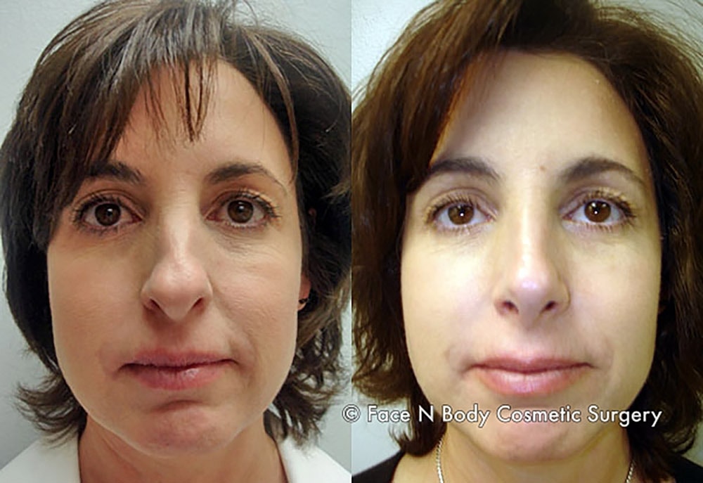 Rhinoplasty Before & After