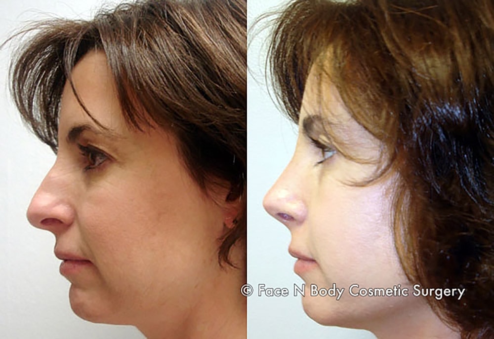 Rhinoplasty Before & After