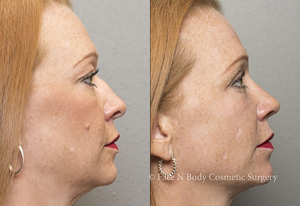 Rhinoplasty Before & After