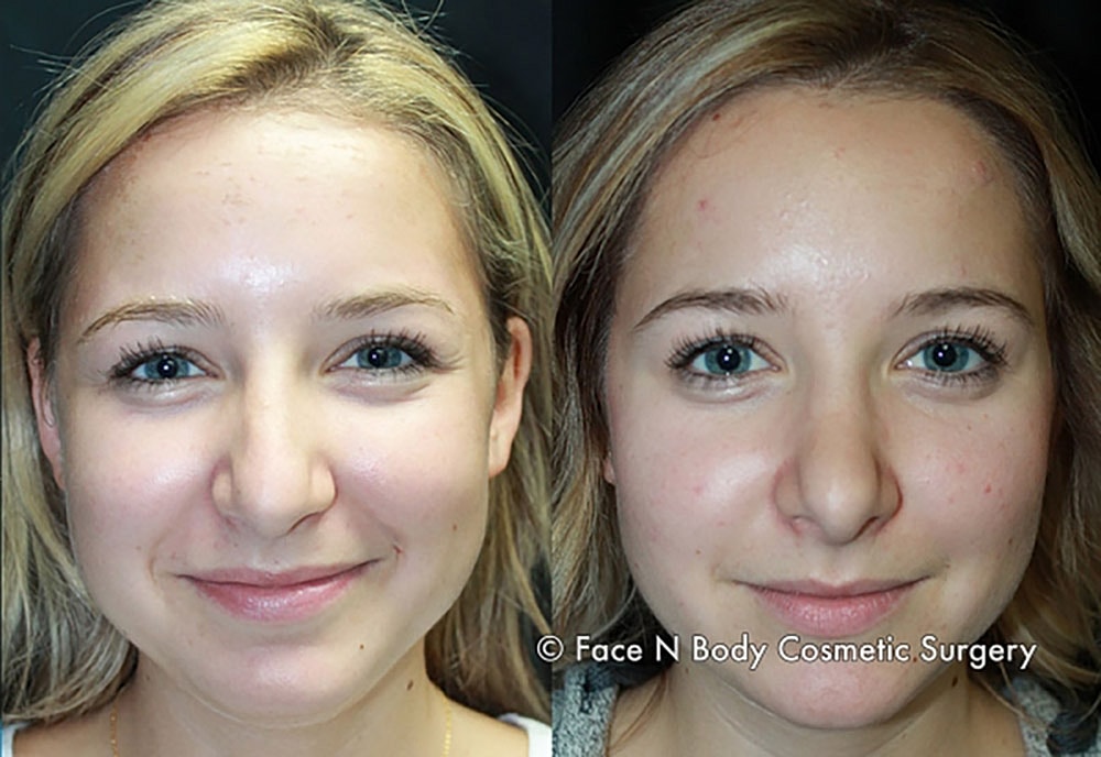 Rhinoplasty Before & After