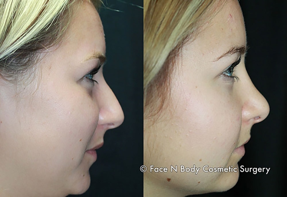 Rhinoplasty Before & After