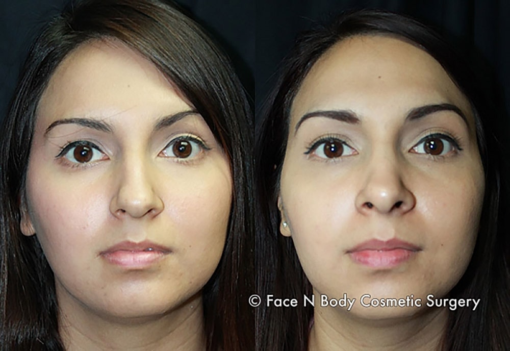 Rhinoplasty Before & After