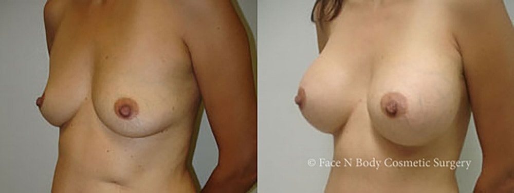 Breast Augmentation Before & After