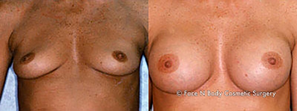Breast Augmentation Before & After