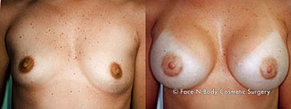 Breast Augmentation Before & After