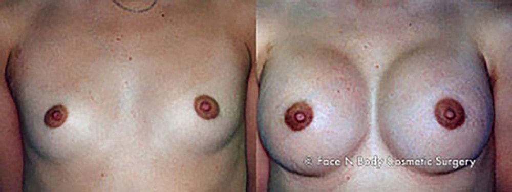 Breast Augmentation Before & After