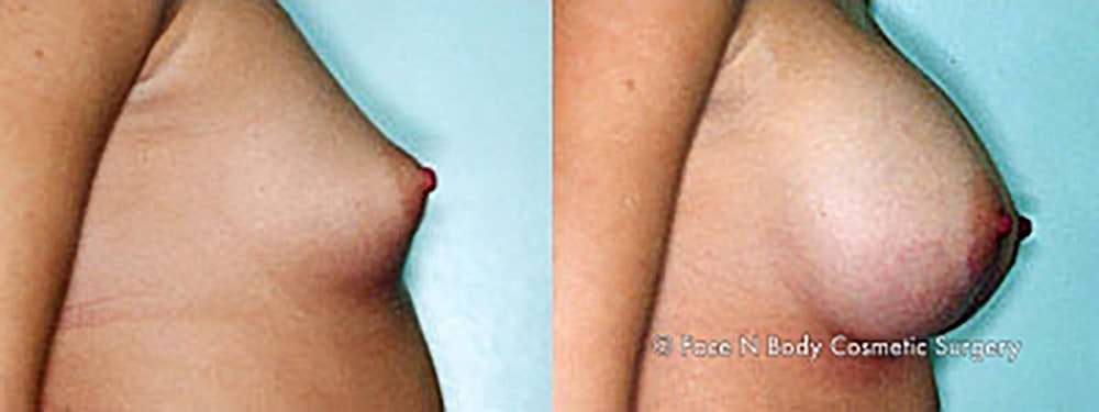 Breast Augmentation Before & After