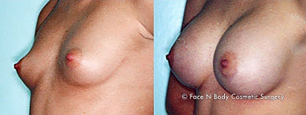 Breast Augmentation Before & After