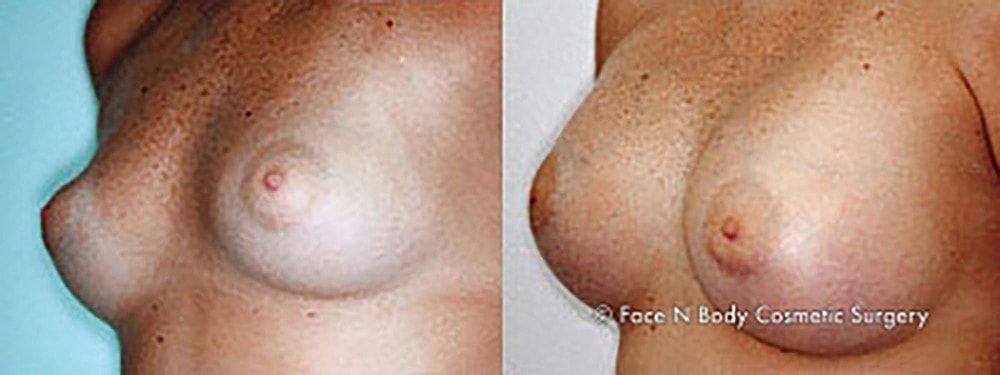 Breast Augmentation Before & After