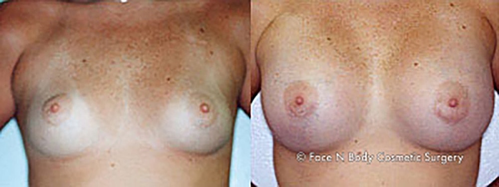 Breast Augmentation Before & After