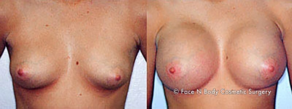 Breast Augmentation Before & After