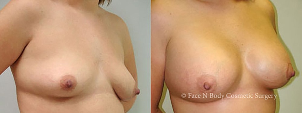 Breast Augmentation Before & After