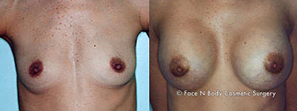 Breast Augmentation Before & After