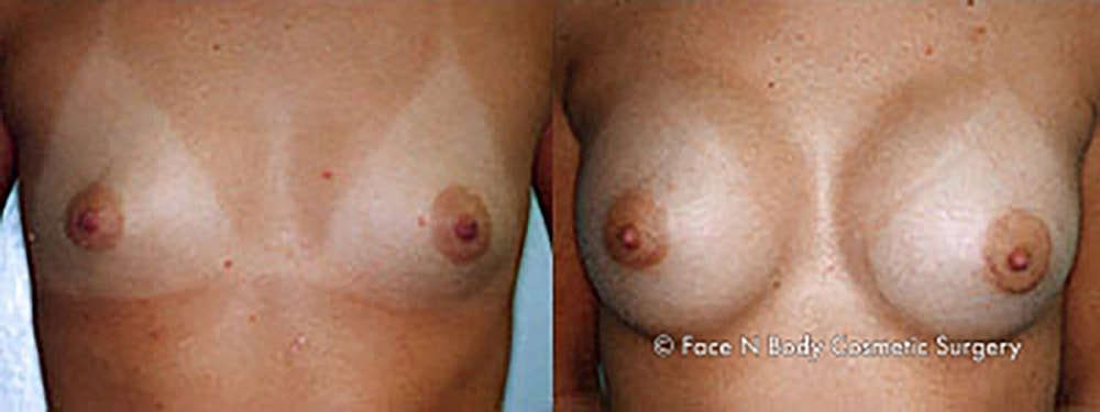 Breast Augmentation Before & After