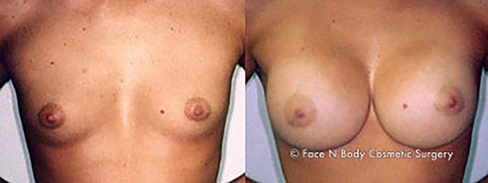 Breast Augmentation Before & After