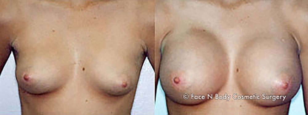 Breast Augmentation Before & After