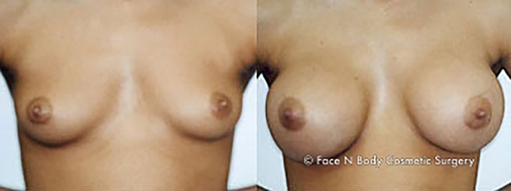 Breast Augmentation Before & After