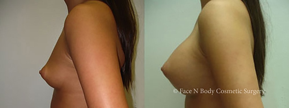 Breast Augmentation Before & After