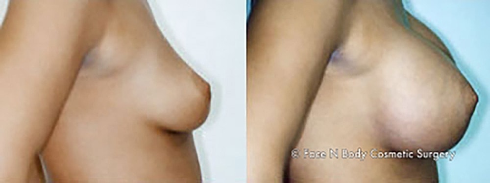 Breast Augmentation Before & After