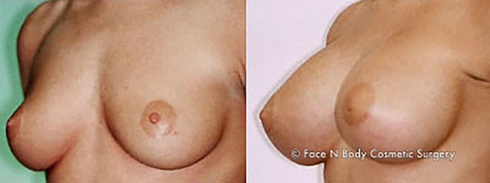 Breast Augmentation Before & After