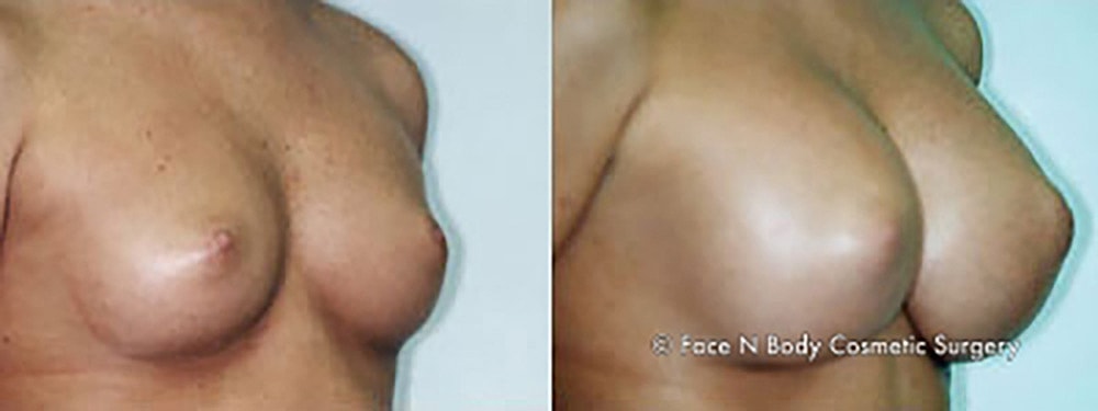 Breast Augmentation Before & After