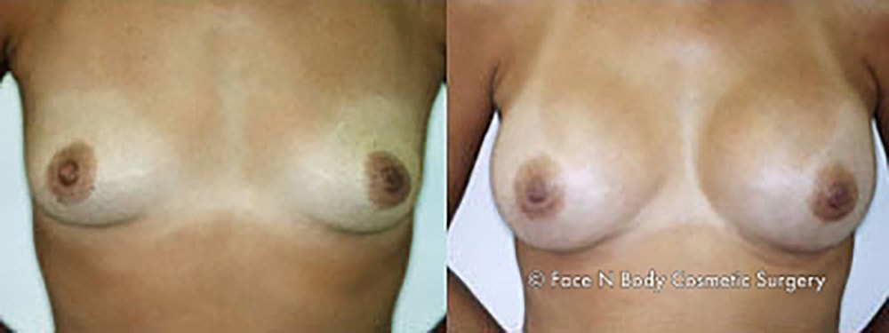 Breast Augmentation Before & After