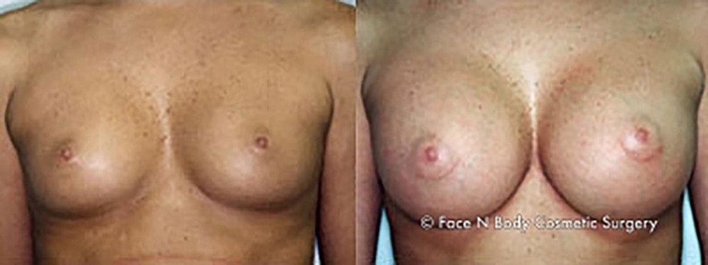 Breast Augmentation Before & After