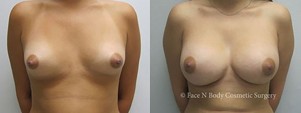 Breast Augmentation Before & After