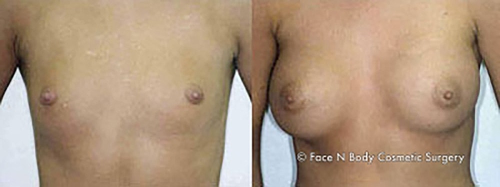 Breast Augmentation Before & After
