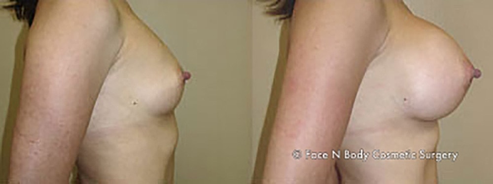 Breast Augmentation Before & After