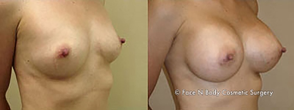 Breast Augmentation Before & After